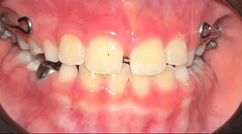 Class III Malocclusion