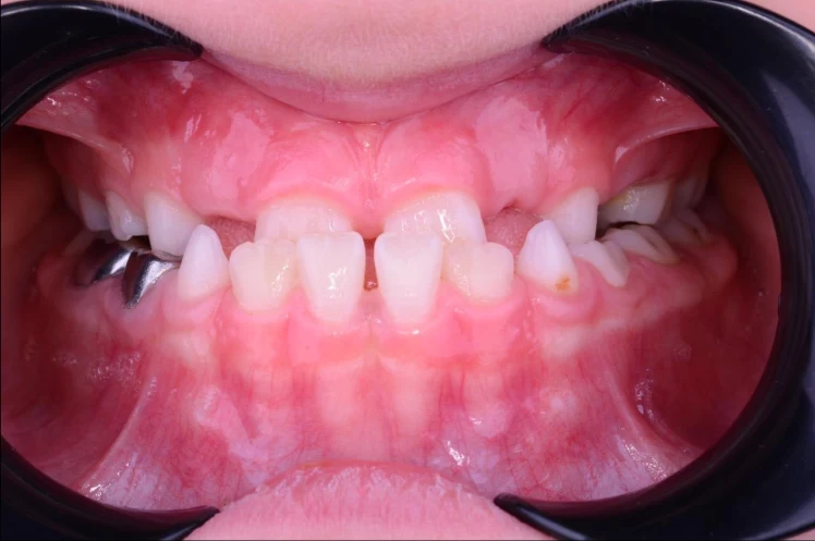 Intraoral view - frontal