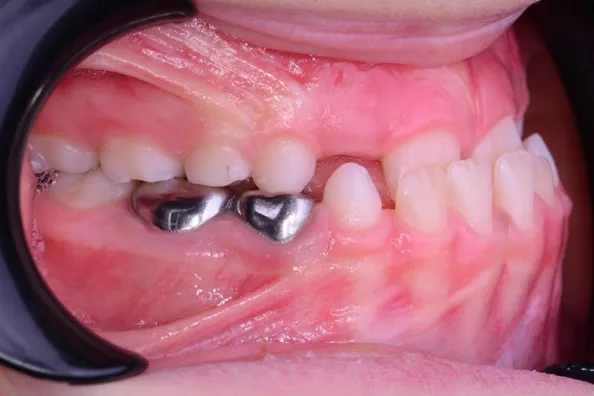 Intraoral view - left side