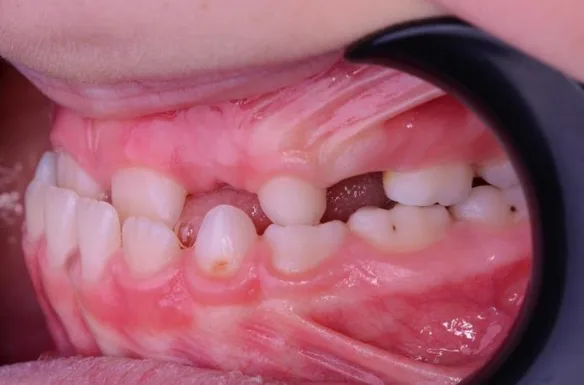 Intraoral view - right side