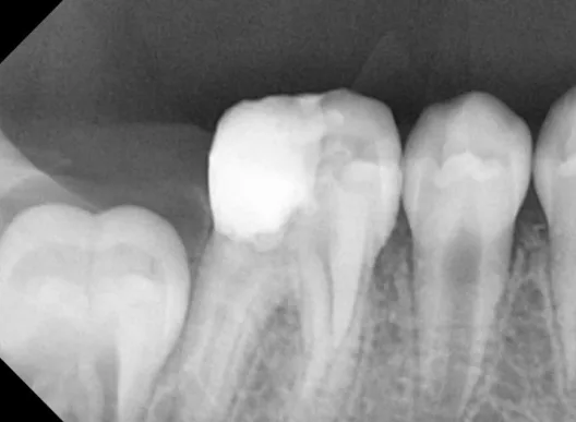 After Treatment - Successful direct pulp capping