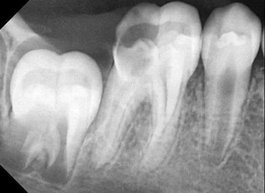 Before Treatment - Carious lower first permanent molar