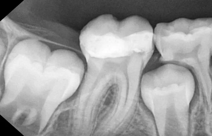 After Treatment - Successful direct pulp capping