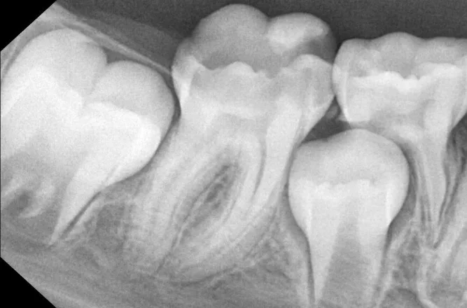 Direct Pulp Capping with MTA