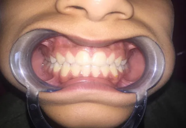 Post-treatment result showing corrected occlusion