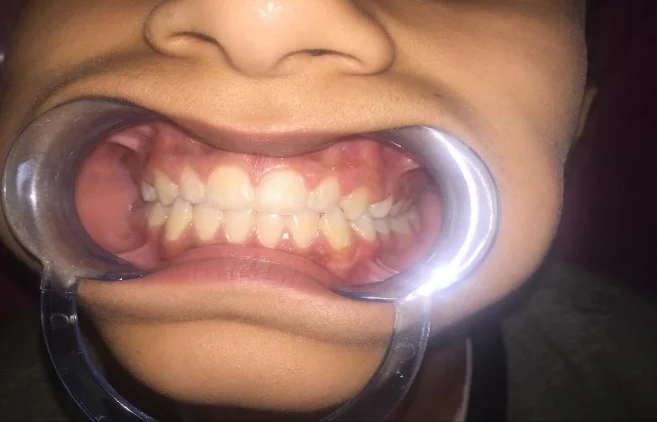 Post-treatment smile showing improved alignment