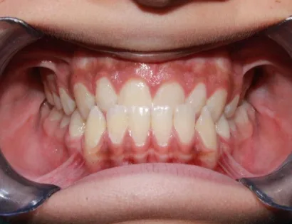 Frontal intraoral view showing anterior crossbite