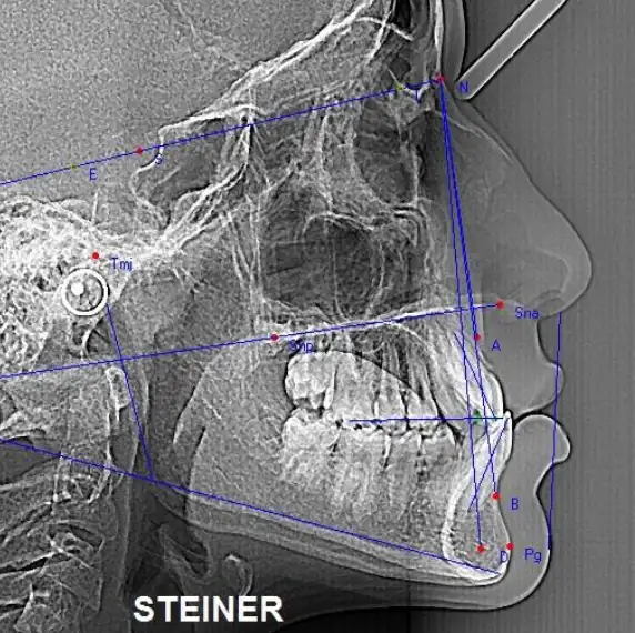 Lateral cephalometric radiograph with Steiner analysis tracings
