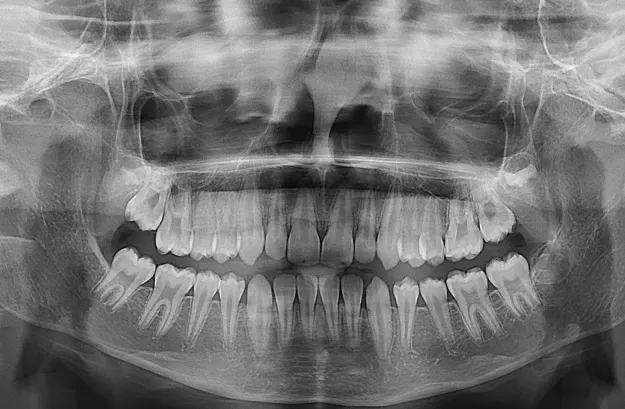 Pseudo Class III Malocclusion