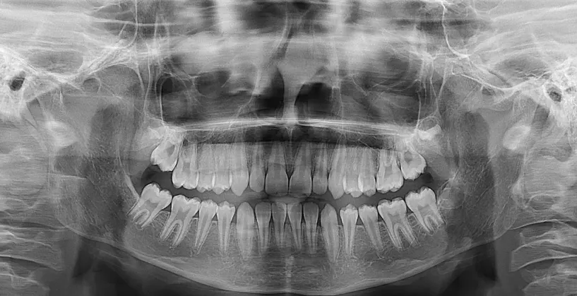 Panoramic radiograph showing permanent dentition