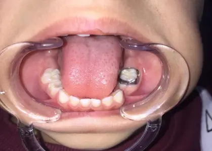 Band seated on the tooth