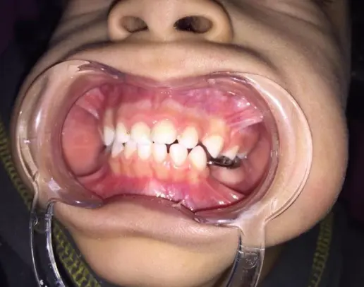 Checking for occlusion after cementation of band and loop space maintainer