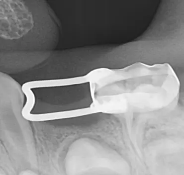 Intraoral periapical radiograph after insertion