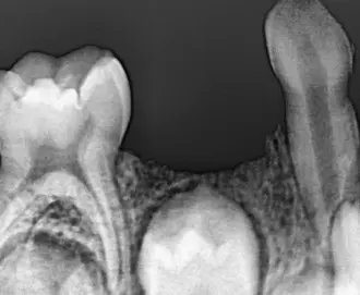 Zirconia space maintainer case overview - Image 2