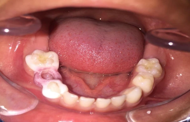 Cementation of zirconia band and loop space maintainer