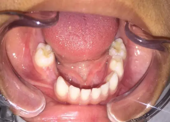 Zirconia Space Maintainer