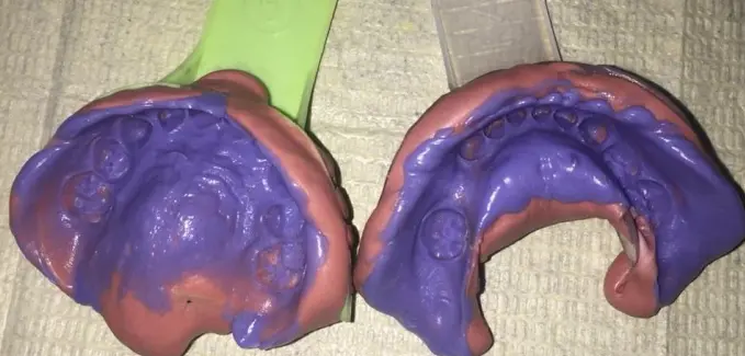 Rubber base impression for zirconia space maintainer - Step 1
