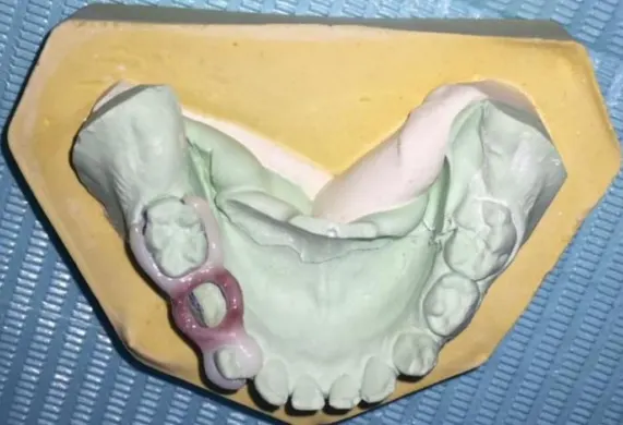 Rubber base impression for zirconia space maintainer - Step 2