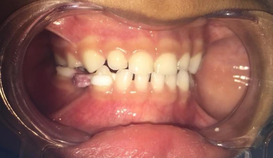 Checking for occlusion after cementation of zirconia band and loop space maintainer