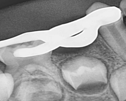 Intraoral periapical radiograph after insertion