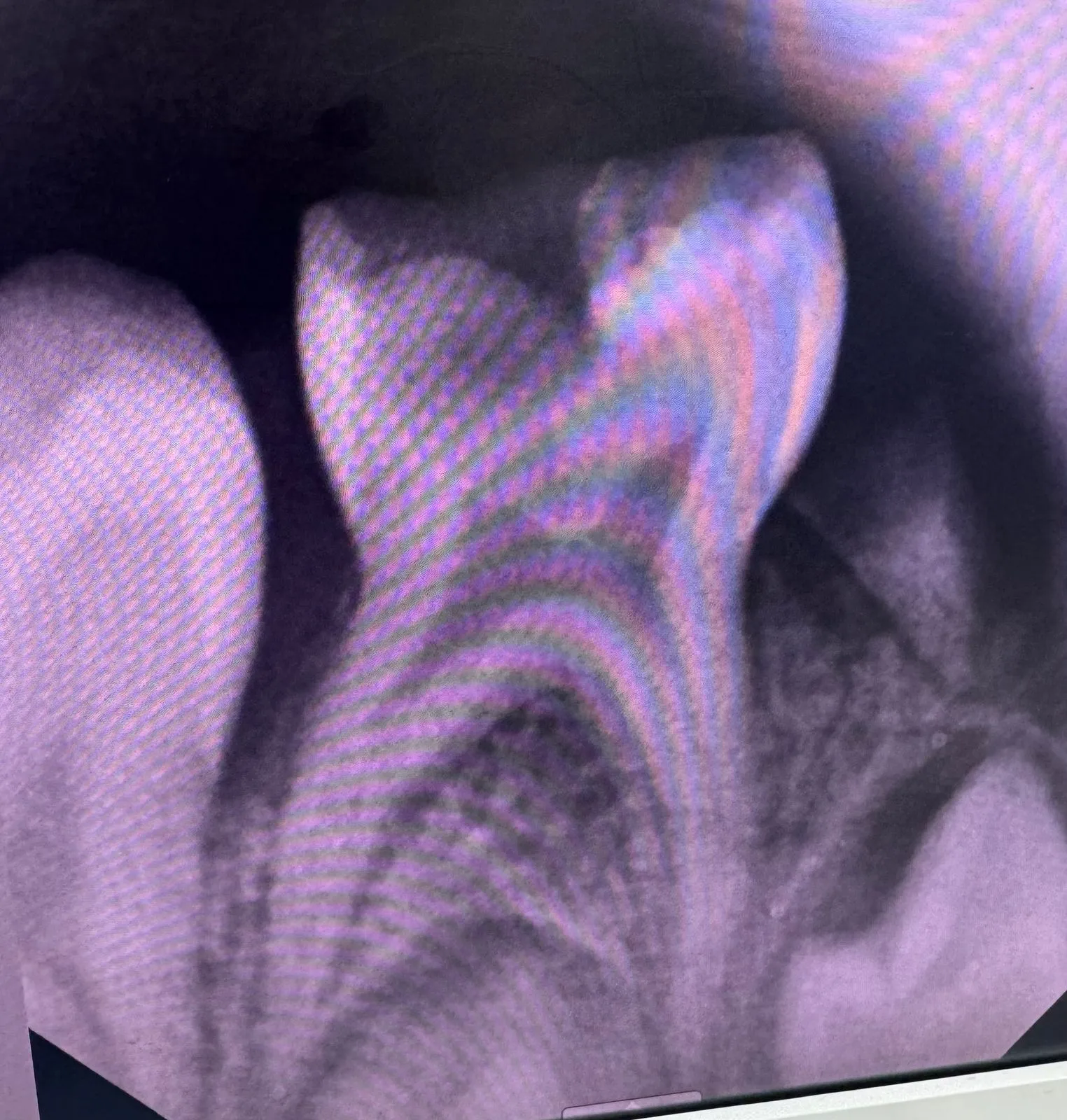 Before treatment