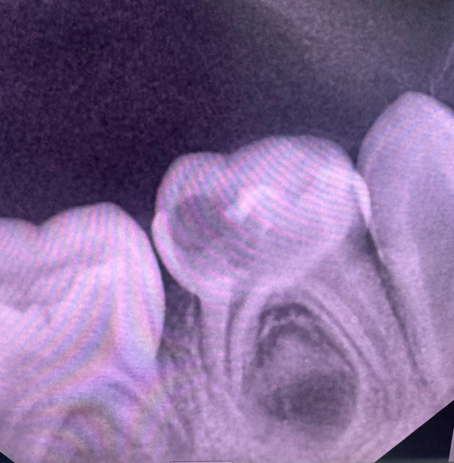 Before treatment