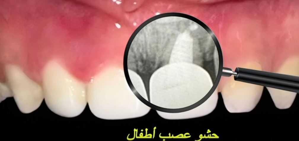 Severe Decay in Primary Anterior Teeth