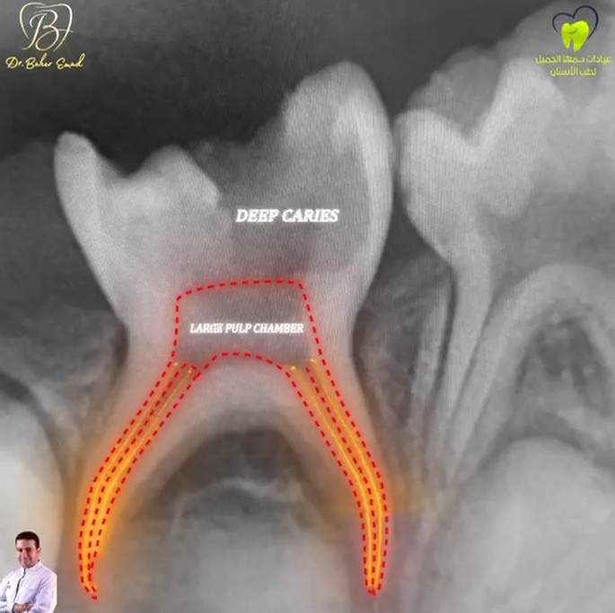 Pulpectomy and Stainless Steel Crown