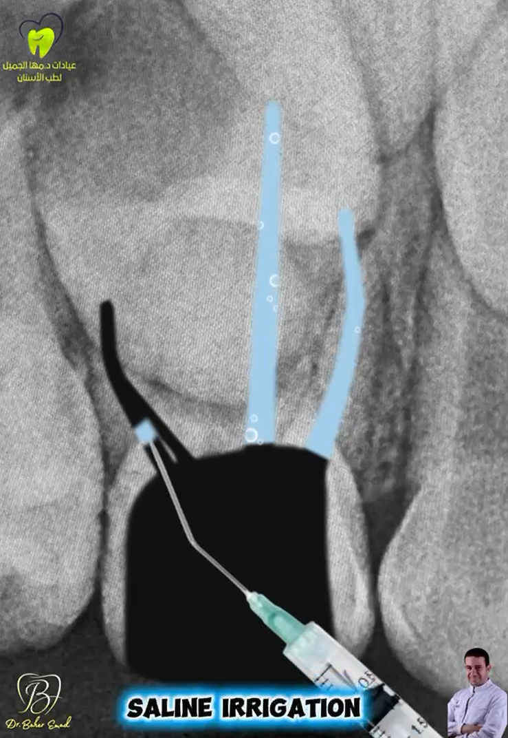 Pulpectomy of Upper Right D