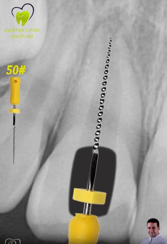 Apexification of Necrotic Upper Central