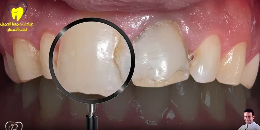Composite Restoration of Upper Incisors